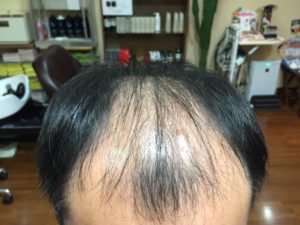 本気最速育毛コース1